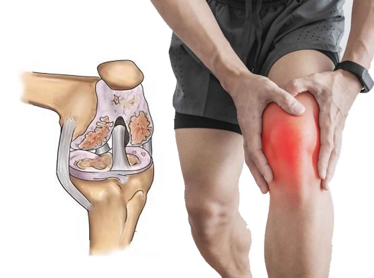 Knee Problems হাঁটুর সমস্যা হলে যে ৫টি ব্যায়াম আপনার জন্য নয়