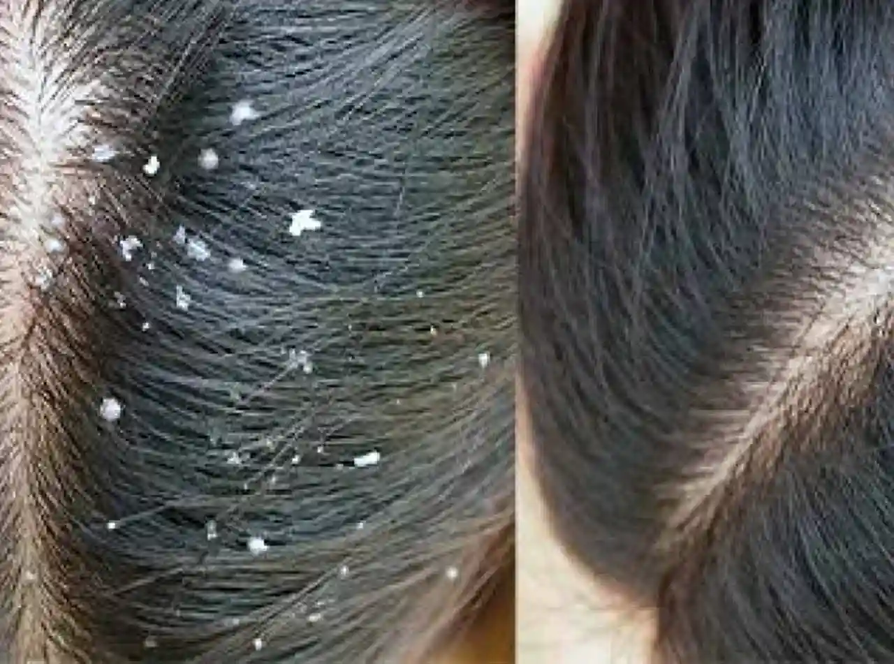 খুশকি থেকে মুক্তি পাওয়ার ১০টি কার্যকরী উপায়