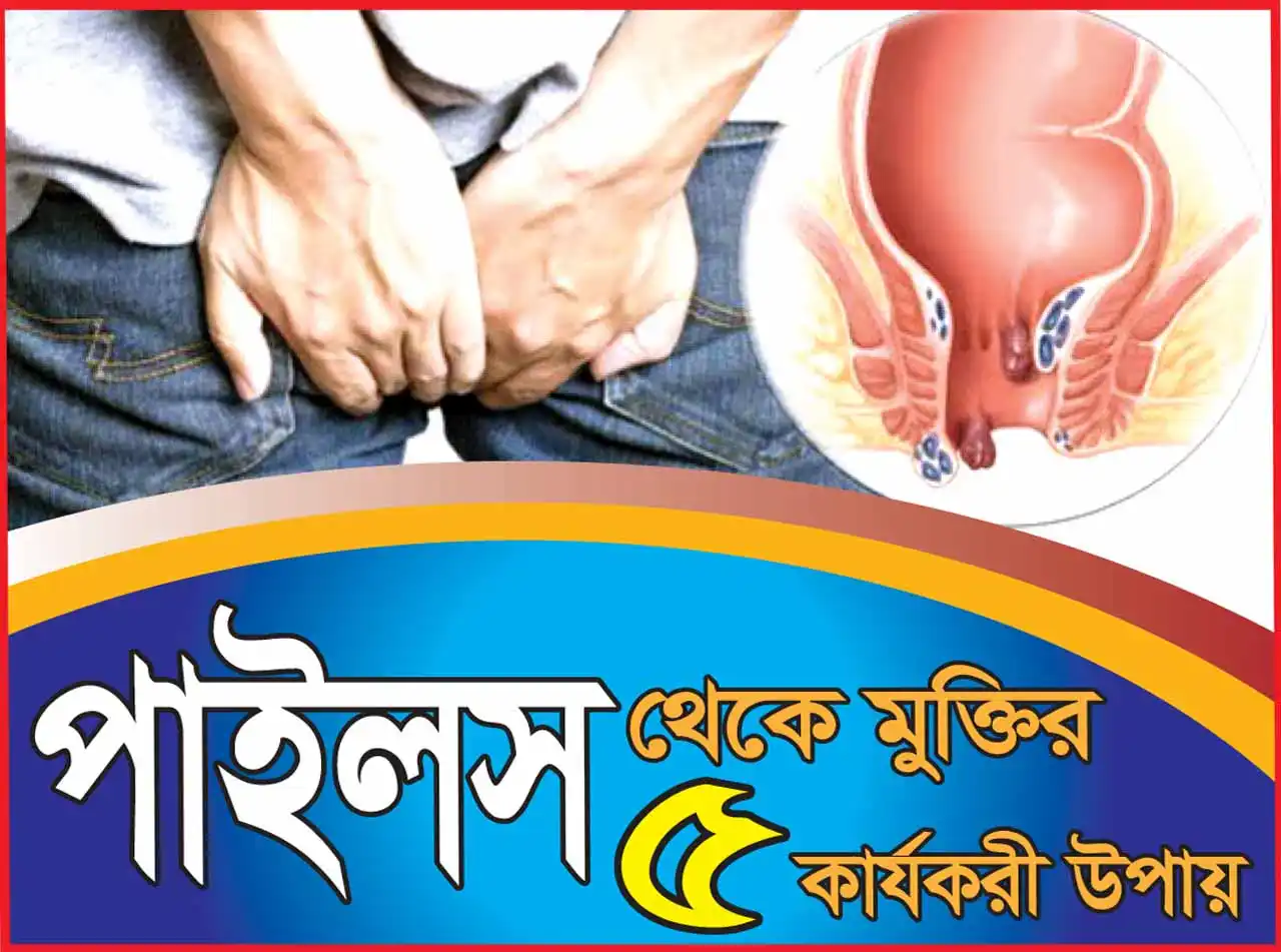 পাইলস থেকে মুক্তির ৫ কার্যকরী উপায়