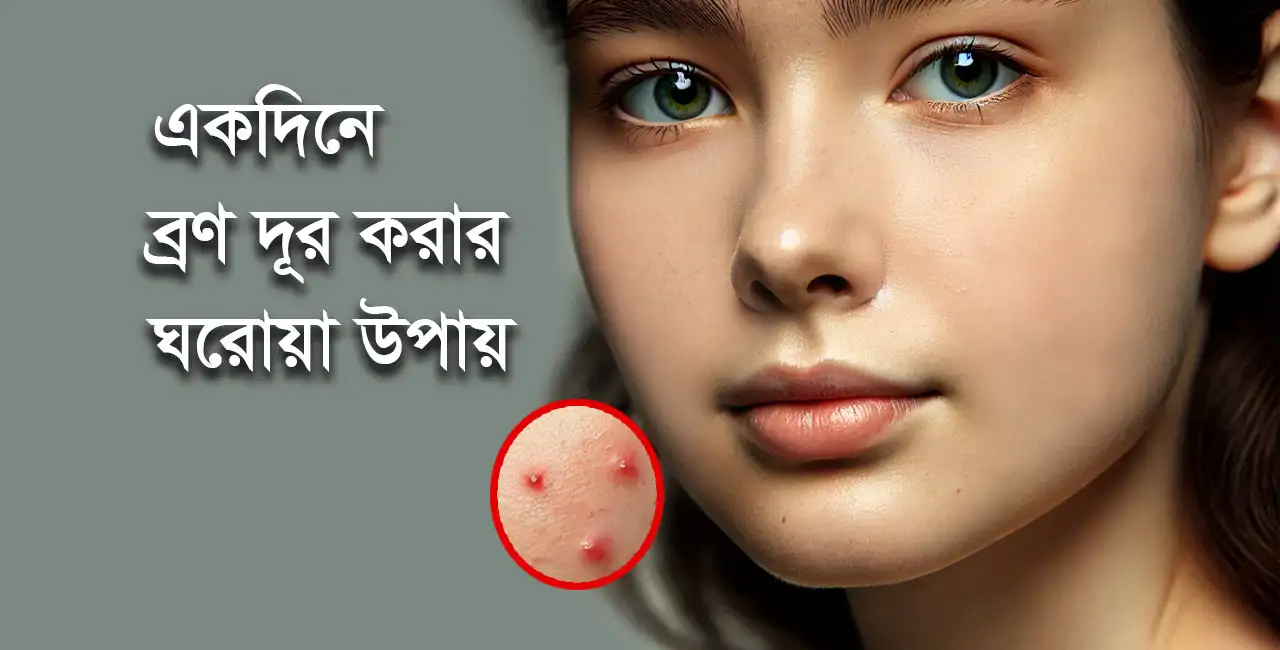 একদিনে ব্রণ দূর করার ঘরোয়া উপায়